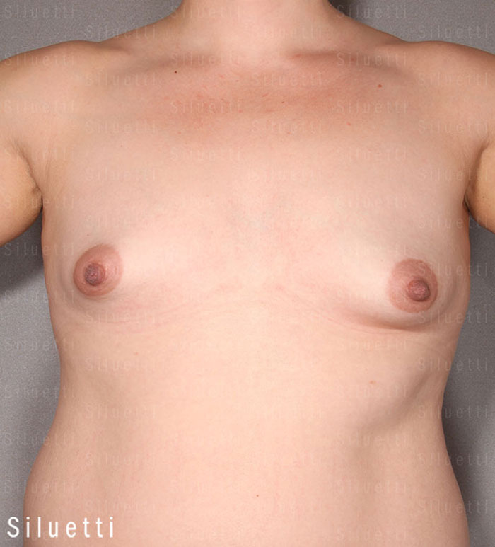 Siluetti - rintojen suurennus rasvansiirrolla ennen ja jlkeen