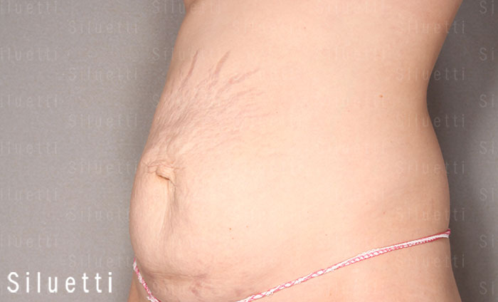Siluetti - vatsan muotoiluleikkaus ennen ja jlkeen