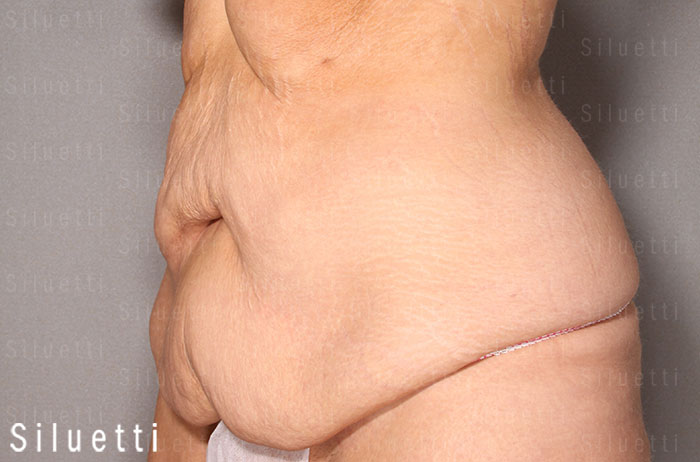 Siluetti - abdominoplastia ennen ja jälkeen