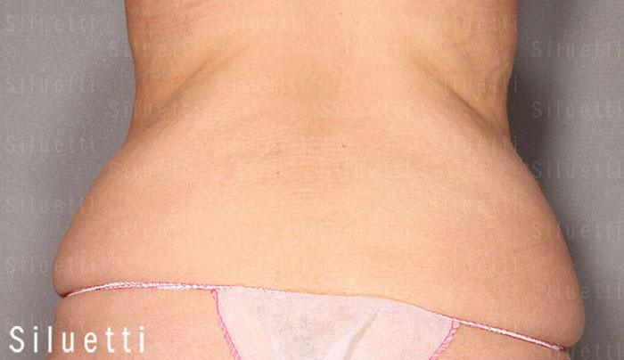 Siluetti - abdominoplastia ennen ja jälkeen