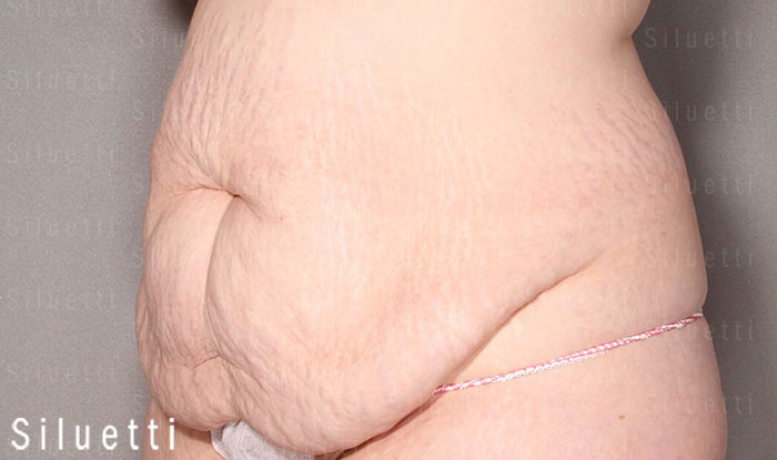Siluetti - vatsan muotoiluleikkaus ennen ja jlkeen