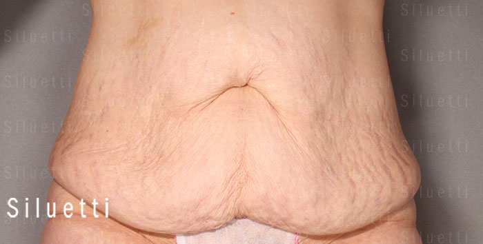 Siluetti - vartalon muotoiluleikkaus ennen ja jlkeen
