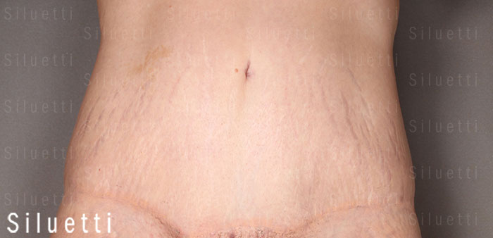 Siluetti - vartalon muotoiluleikkaus ennen ja jlkeen